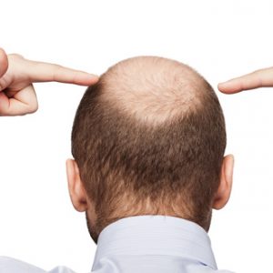 Surgery to improve baldness